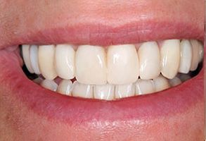 Sendero Dental Studio | Teeth Whitening, Ceramic Crowns and Veneers